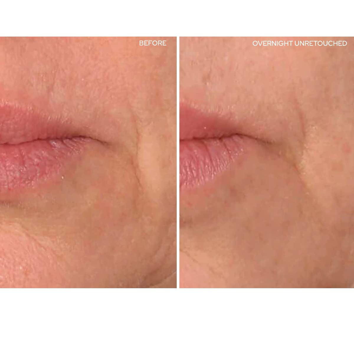 SiO Beauty Eye and Smile SuperLift - Eye & Lip Anti-Wrinkle Silicone Patches - Reduce Smile and Under Eye Wrinkles Overnight