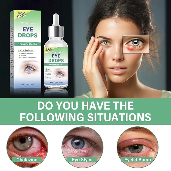 Stye Eye Treatment, Stye Eye Drops Serum for Styes Chalazion and Blepharitis, Chalazion Remover Fast Relief, Restore Healthier Eye Skin, 30ml