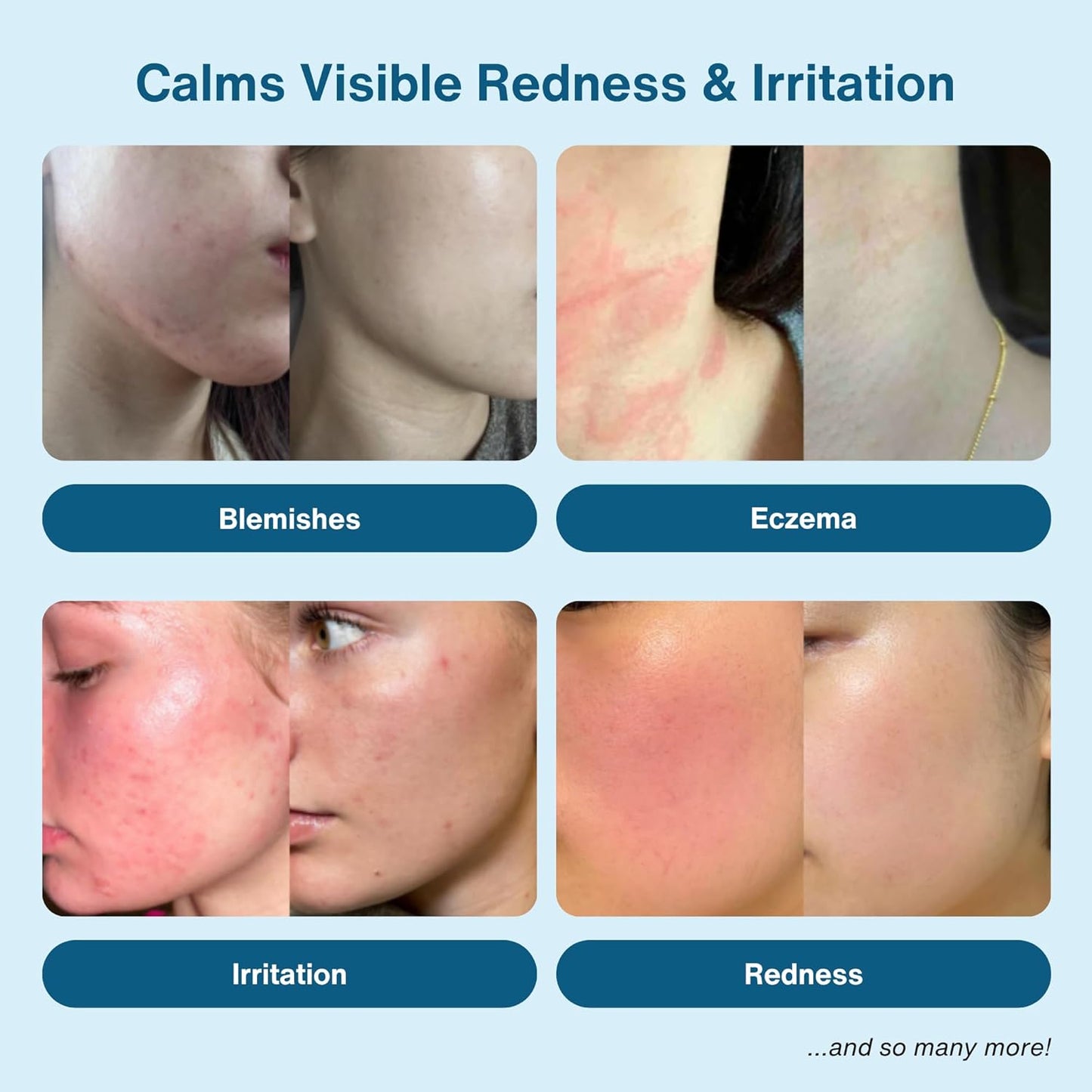 Hypochlorous Acid Spray – HOCl Face & Skin Mist for Acne, Eczema & Irritation – Multi-Purpose Skin Repair – Eyelid Cleanser, Post-Workout, Post-Procedure, Scalp, Sensitive Skin TSA 2 oz